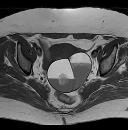Mature Cystic Ovarian Teratoma With Rokitansky Nodule Image