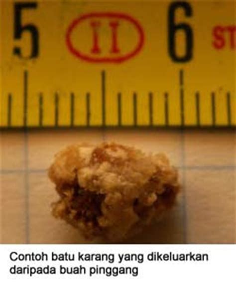 Jika tidak dirawat dengan segera, boleh menyebabkan komplikasi kepada buah pinggang. Mesin Terapi Elektrostatik Golden Wellness Hebat: Mesin ...