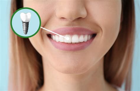 Dental Implants King Centre Dental Dentist Va 22315