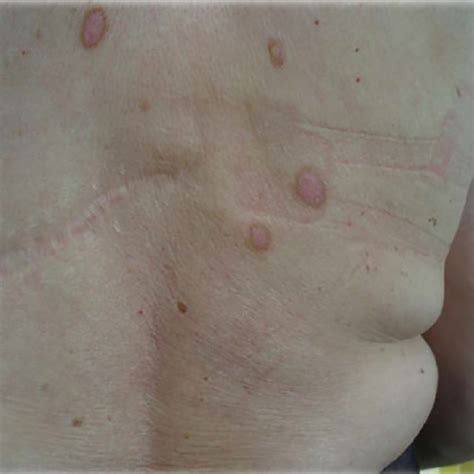 Firm And Well Circumscribed Nodules On The Upper Back Download