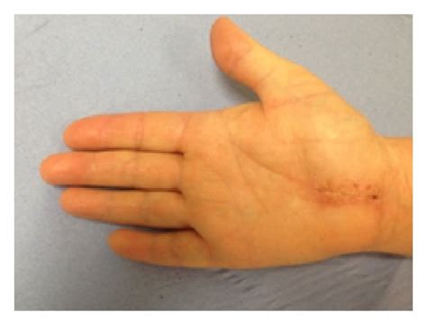 Typical Appearance Of A Healed Carpal Tunnel Wound At 6 Weeks