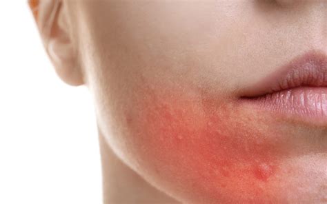Allergy Rash On Lips