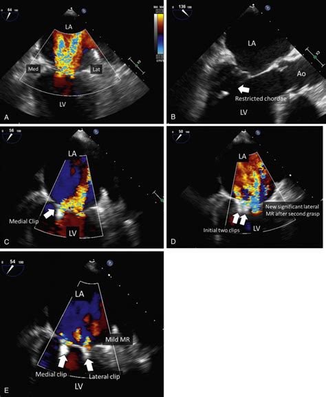Challenges Of Transcatheter Therapy For Functional Mitral Regurgitation