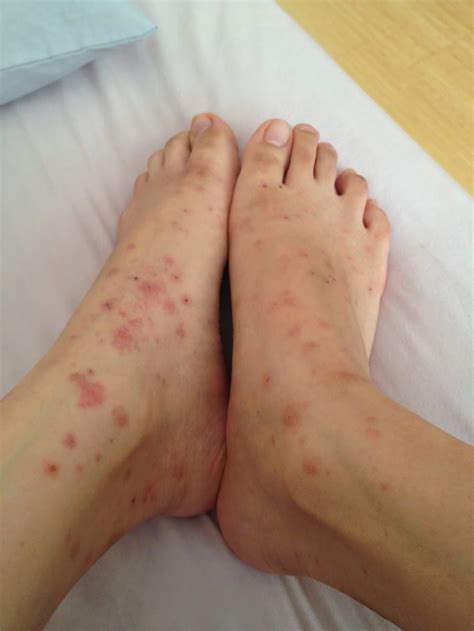 Skin Disease Types Scabies