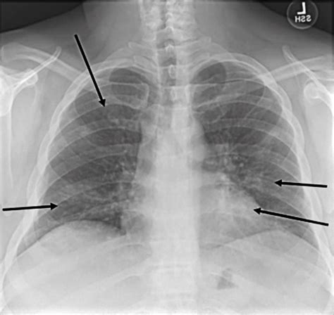 A 40-Year-Old Man with Cough and Fever During the COVID-19 ...