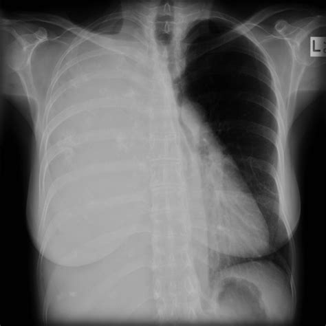 Mesothelioma invades the chest wall or involves the esophagus, heart, or pleura on both sides. Mesothelioma - sarcomatoid | Image | Radiopaedia.org