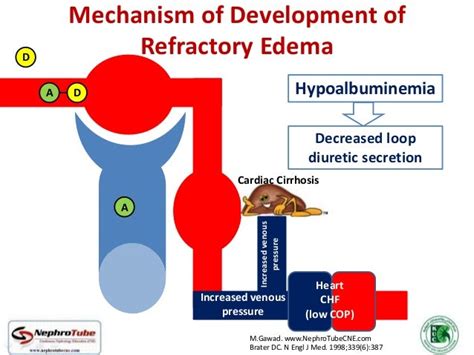 Refractory Edema With Chf Stepwise Approaches V Nephrology Perspec