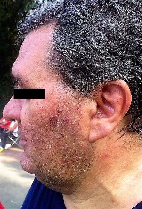 Rosacea As An Inflammatory Disease Scarborough And Augusta Me Maine