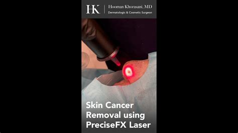 Superficial Skin Cancer Removal Using Precisefx Ablative Laser By Dr