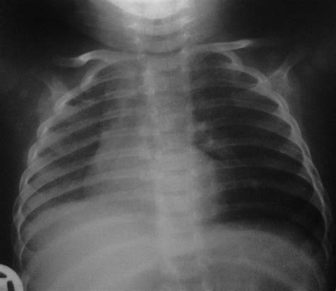 Tracheal Bronchus Associated With Unilateral Absence Of Pulmonary