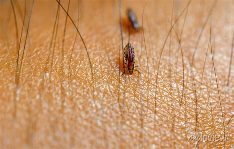 Louse Head Lice Feed On Blood On Human Skin Posters For The Wall