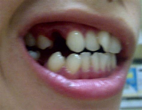 2 teeth whitening at the dentist's surgery. dontdoubthappiness: Orthodontics ... braces braces braces