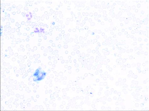 Peripheral Blood Smear Showing Leukocytosis Normochromic Red Blood