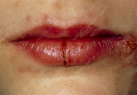 Cracked Lips Of Girl Affected By Herpes Simplex Stock Image M170