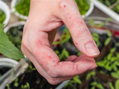 Mild Poison Ivy Rash On Hands