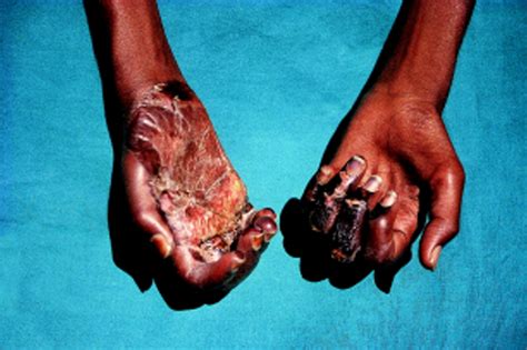 Leprosy elimination—a virtual phenomenon or a reality? | The BMJ