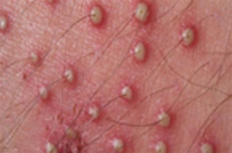 Symptoms of an infected ingrown hair. Folliculitis