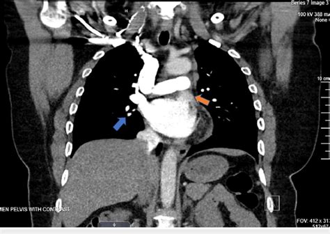 Ct Of The Chest Contrast Enhanced Ct Of The Chest Showing Right Hilar