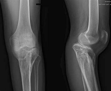 The Radiographic Study Demonstrated The Malunion Of The Intra Articular