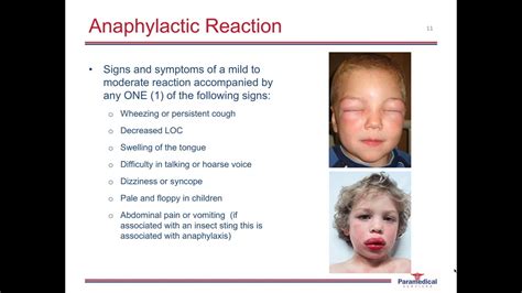 Allergy And Anaphylaxis Youtube
