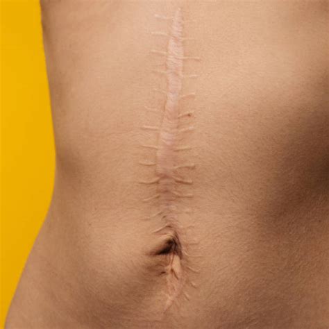 All 104 Images Scars From Mohs Surgery Photos Full Hd 2k 4k