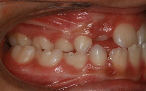 Clase Iii Maloclusiones En Ortodoncia Clínica Dental Larrañaga