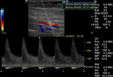 Arterial Duplex Ultrasonography The Society For Vascular Medicine