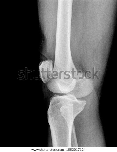 X Ray Knee Picture Radiograph Black Stock Photo 1553017124 Shutterstock