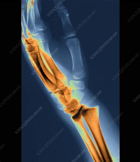 Fractured Wrist X Ray Stock Image C0551119 Science Photo Library