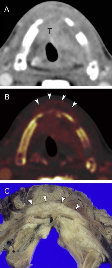 Primary Staging Of Laryngeal And Hypopharyngeal Cancer Ct Mr Imaging