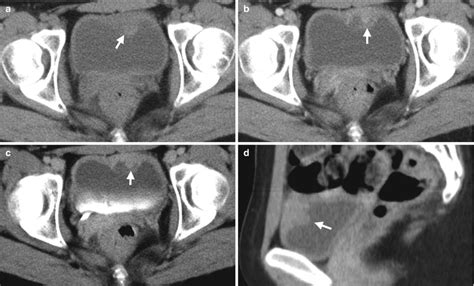 Urinary Tract Infection And Inflammation Radiology Key