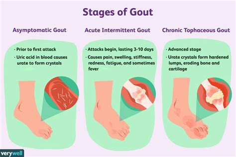 Gout Symptoms Causes Types And Treatment Santripty