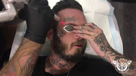 4 surgical methods to remove a permanent tattoo. FACE TATTOO REMOVAL | EXPIRED LASER STUDIO - YouTube
