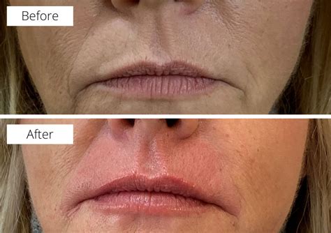 Wrinkle And Fold Fillers Melior Clinics