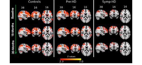 Spatial Distribution Of Fmri Activity During 1 Back Working Memory