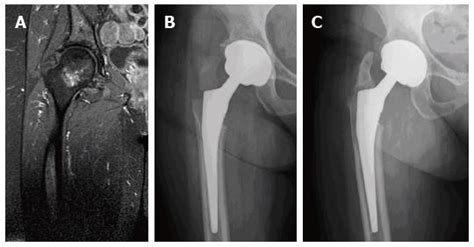Trochanter/calcar preserving reconstruction in tumors ...
