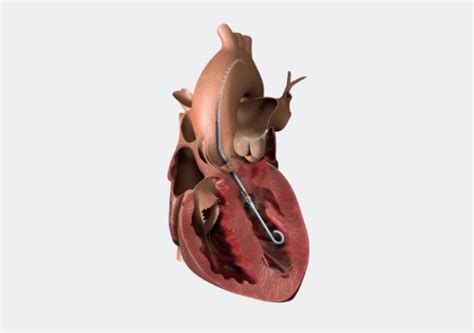 Abiomed Receives Two Fda Approvals Related To Impella Heart Pumps