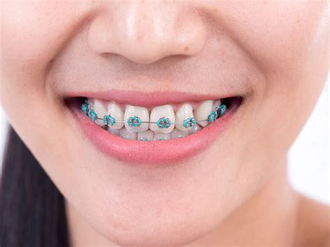This helps the orthodontist estimate how long you'll need to wear braces. 13 Main Things You Need To Know About Getting Braces in ...