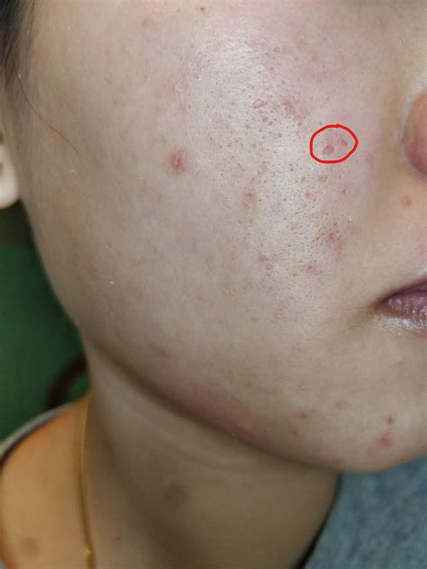 Skin Concerns Large Icepick Scar For Over A Year Large Pores And