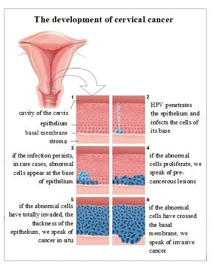 How To Detect Hpv In Women Ademploy19