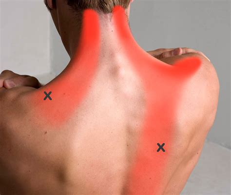 Scalenes Trigger Points