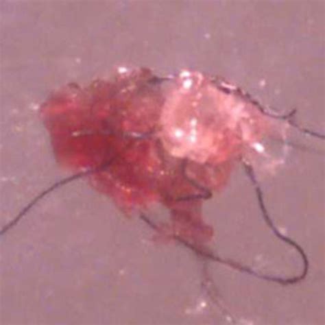 What Is Morgellons Disease Is It A Physical Or