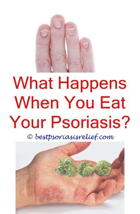 Psoriasiselbow Guttate Psoriasis Diet Plan Cbd Lotion For Psoriasis