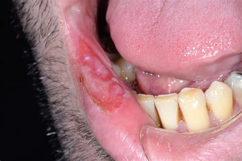 Oral Syphilis A Case Report Scottish Dental Magazine Scottish