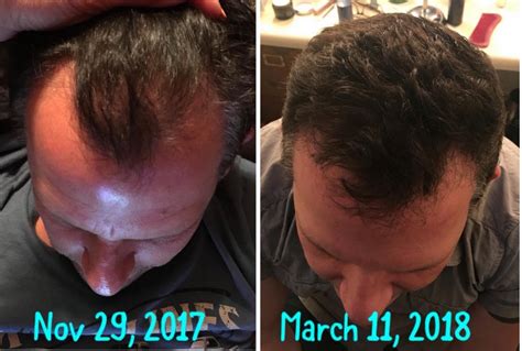 Regrow Hair Products 7 Real Men Tell All With Before And After Pictures