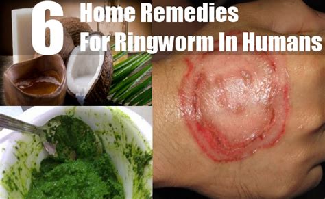 6 Best Home Remedies For Ringworm In Humans Ringworm Home Remedies