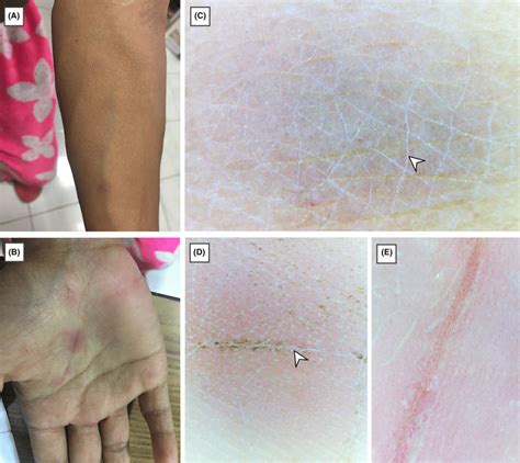 A And B Clinically Erythematous Maculopapular Rash Can Be Seen Over