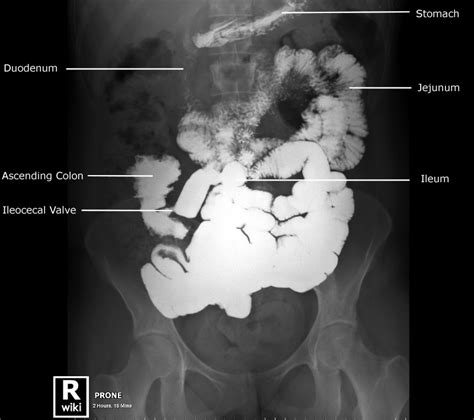 Four abdominal quadrants and nine abdominal regions in anatomy and physiology, you'll learn how to divide the abdomen into nine different regions and four different quadrants. Labeled Abdominal XRay Anatomy - Small Bowel Series ...