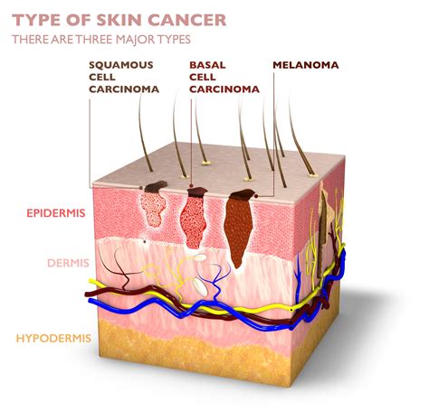 Types Of Skin Cancer Diagram