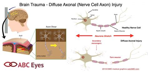 Diffuse Axonal Nerve Cell Axon Injury Abc Eyes Pediatric